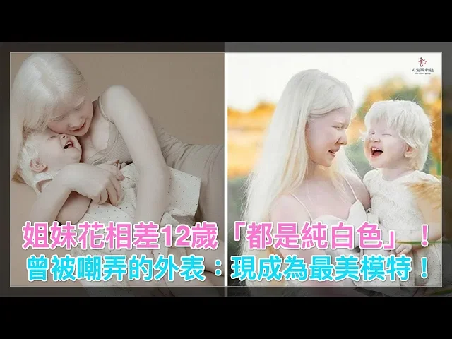 姐妹花相差12歲「都是純白色」!曾被嘲弄的外表: 現成為最美模特!